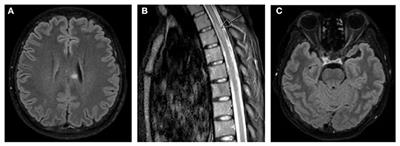 Eculizumab for acute relapse of neuromyelitis optica spectrum disorder: Case report